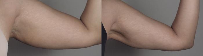 Upper Arm Rejuvenation Case 1198 Before & After arms | Paramus, New Jersey | Parker Center for Plastic Surgery