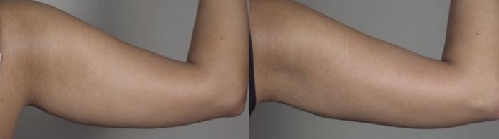 Upper Arm Rejuvenation Case 1198 Before & After back arms | Paramus, New Jersey | Parker Center for Plastic Surgery