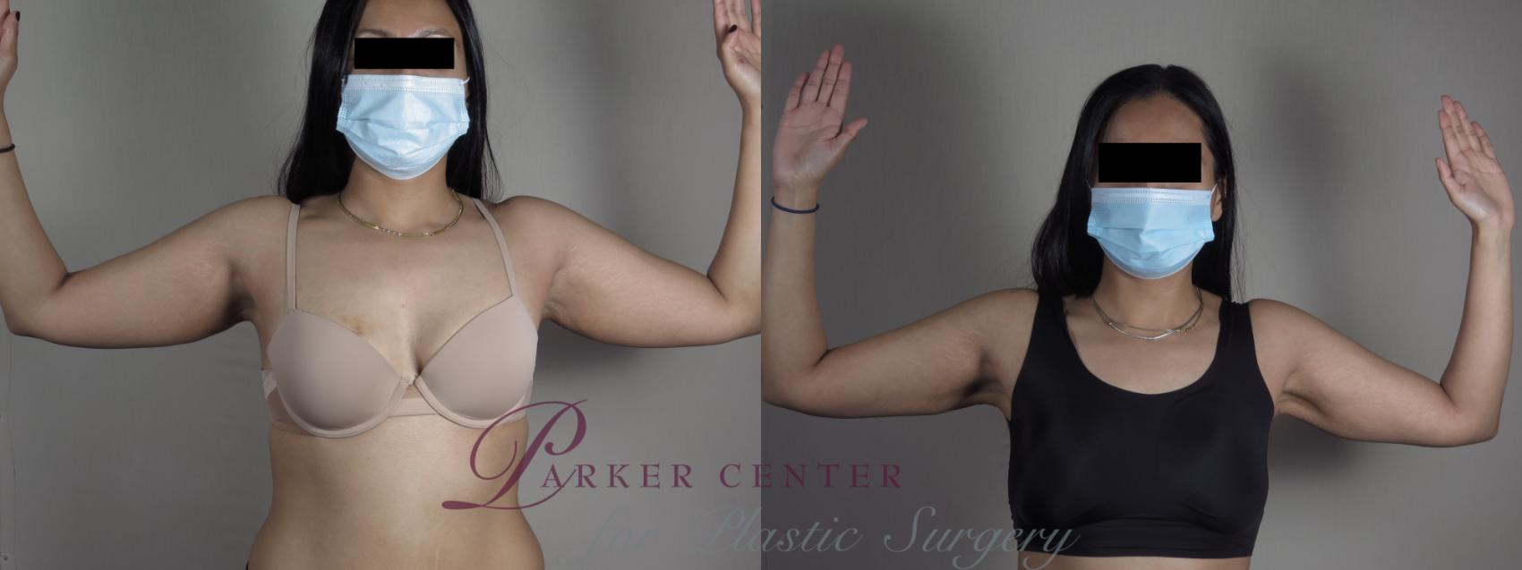 Upper Arm Rejuvenation Case 1198 Before & After View #1  | Paramus, NJ | Parker Center for Plastic Surgery