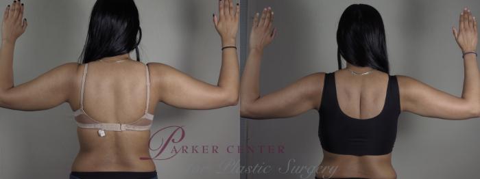 Upper Arm Rejuvenation Case 1198 Before & After View #2 | Paramus, NJ | Parker Center for Plastic Surgery