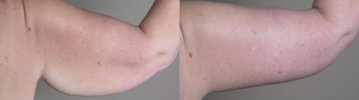 Upper Arm Rejuvenation Case 1286 Before & After arms | Paramus, New Jersey | Parker Center for Plastic Surgery