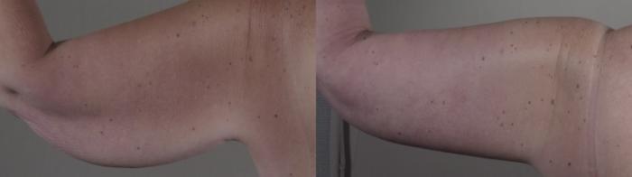 Upper Arm Rejuvenation Case 1286 Before & After back 2 | Paramus, New Jersey | Parker Center for Plastic Surgery