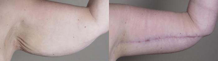 Upper Arm Rejuvenation Case 1286 Before & After front arms | Paramus, New Jersey | Parker Center for Plastic Surgery