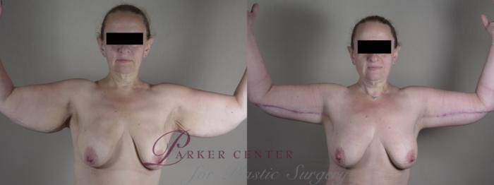 Upper Arm Rejuvenation Case 1286 Before & After Front | Paramus, NJ | Parker Center for Plastic Surgery