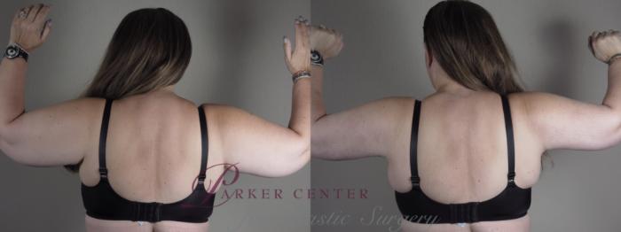 Upper Arm Rejuvenation Case 1287 Before & After Back | Paramus, NJ | Parker Center for Plastic Surgery