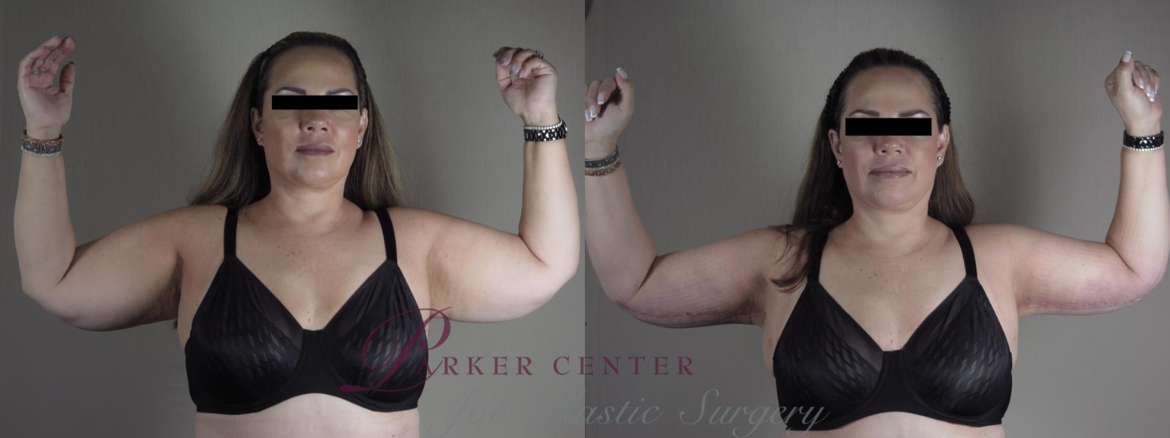 Upper Arm Rejuvenation Case 1287 Before & After Front | Paramus, NJ | Parker Center for Plastic Surgery