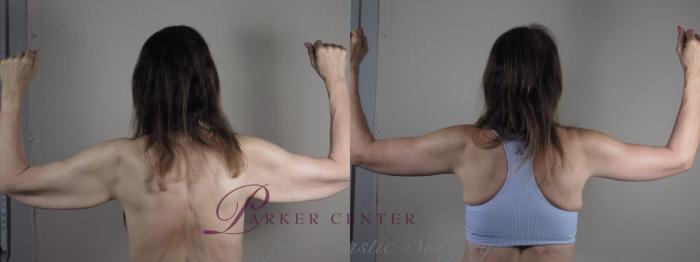 Upper Arm Rejuvenation Case 1303 Before & After Back | Paramus, NJ | Parker Center for Plastic Surgery