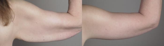 Upper Arm Rejuvenation Case 1303 Before & After back2 | Paramus, New Jersey | Parker Center for Plastic Surgery