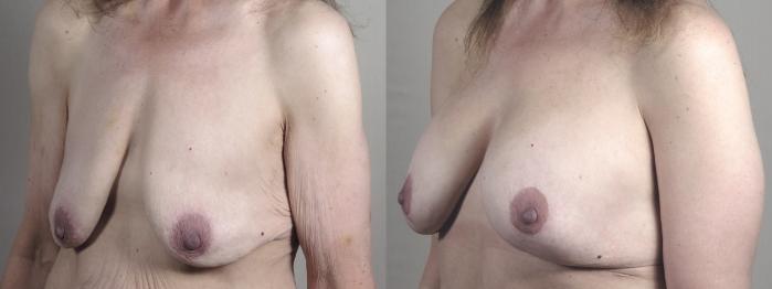 Upper Arm Rejuvenation Case 1303 Before & After breast lift 2 | Paramus, New Jersey | Parker Center for Plastic Surgery