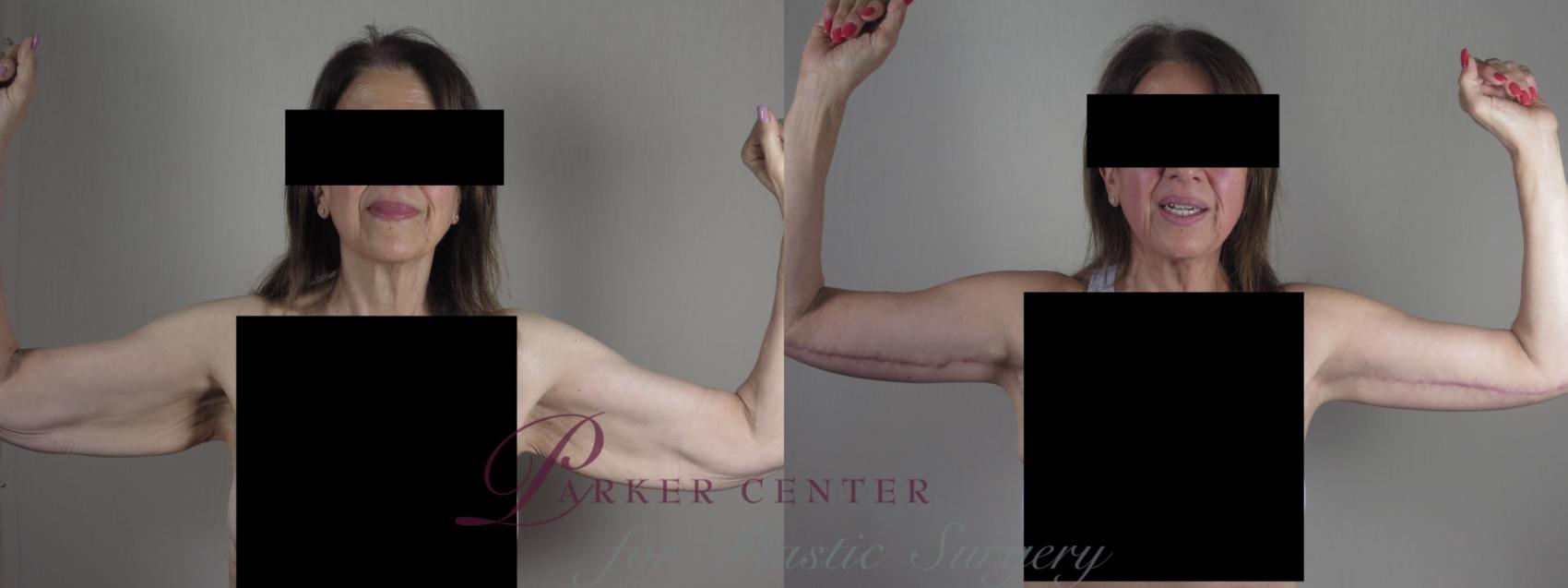 Upper Arm Rejuvenation Case 1303 Before & After Front | Paramus, NJ | Parker Center for Plastic Surgery