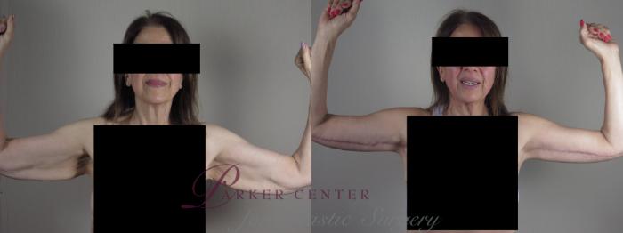 Upper Arm Rejuvenation Case 1303 Before & After Front | Paramus, NJ | Parker Center for Plastic Surgery