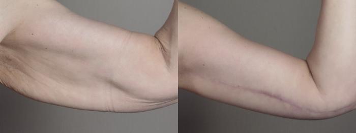 Upper Arm Rejuvenation Case 1303 Before & After Left Side | Paramus, New Jersey | Parker Center for Plastic Surgery