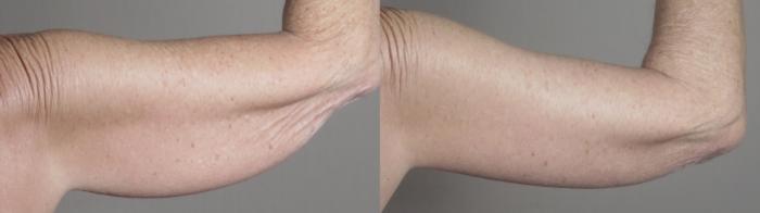 Upper Arm Rejuvenation Case 1308 Before & After back arms 2 | Paramus, New Jersey | Parker Center for Plastic Surgery