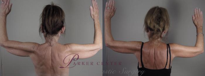 Upper Arm Rejuvenation Case 1308 Before & After Back | Paramus, NJ | Parker Center for Plastic Surgery