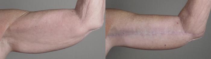 Upper Arm Rejuvenation Case 1308 Before & After front arms | Paramus, New Jersey | Parker Center for Plastic Surgery