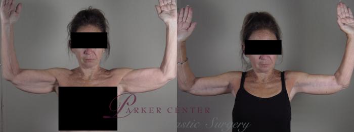 Upper Arm Rejuvenation Case 1308 Before & After Front | Paramus, NJ | Parker Center for Plastic Surgery