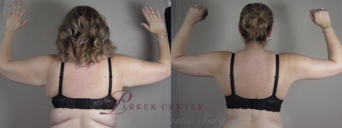 Upper Arm Rejuvenation Case 1316 Before & After Back | Paramus, NJ | Parker Center for Plastic Surgery