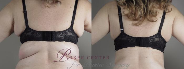 Upper Arm Rejuvenation Case 1316 Before & After back view 2 bra | Paramus, NJ | Parker Center for Plastic Surgery