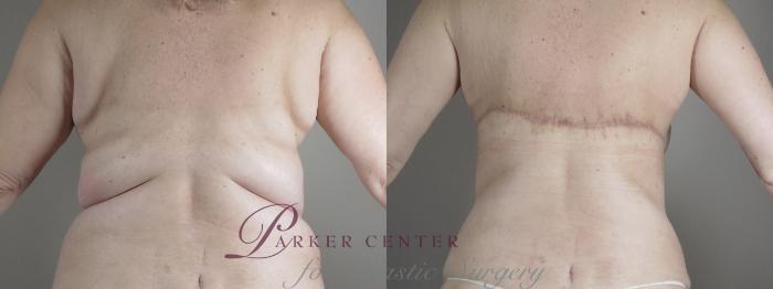 Upper Arm Rejuvenation Case 1316 Before & After front  | Paramus, NJ | Parker Center for Plastic Surgery