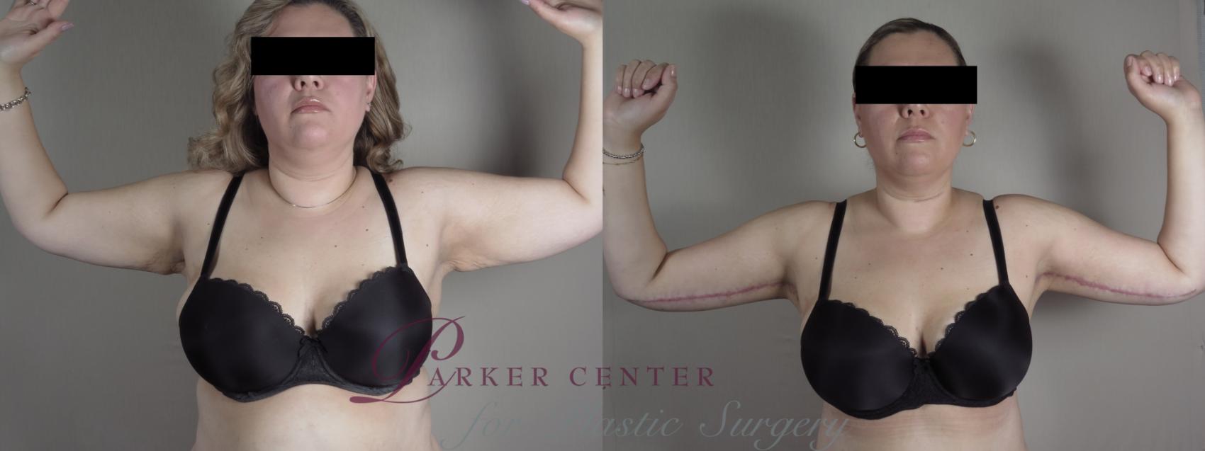 Upper Arm Rejuvenation Case 1316 Before & After Front | Paramus, NJ | Parker Center for Plastic Surgery