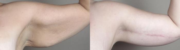 Upper Arm Rejuvenation Case 1320 Before & After arms 2 | Paramus, New Jersey | Parker Center for Plastic Surgery