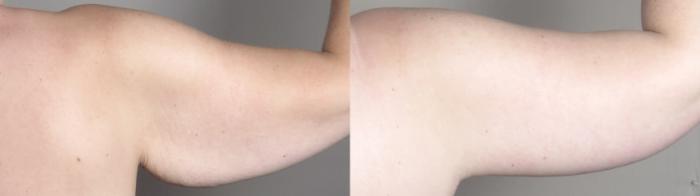 Upper Arm Rejuvenation Case 1320 Before & After back arms 2 | Paramus, New Jersey | Parker Center for Plastic Surgery