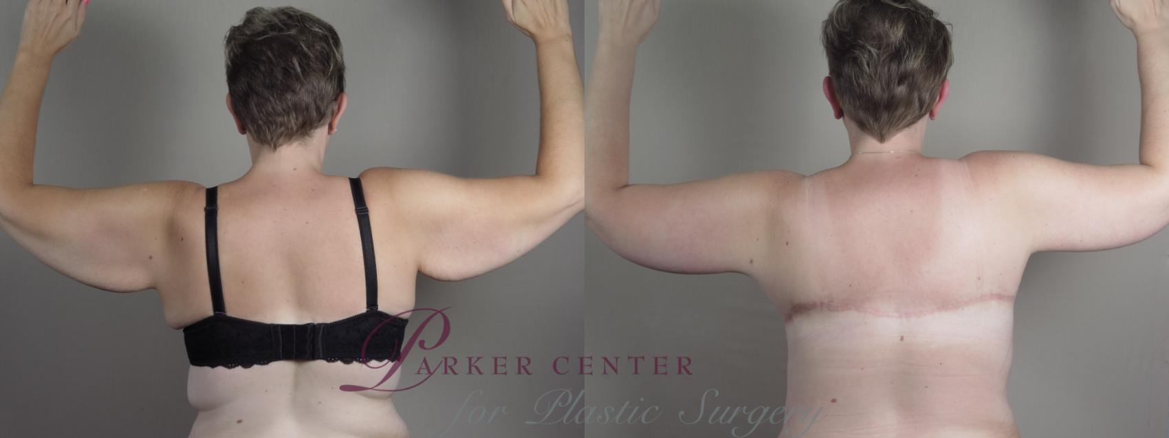 Upper Arm Rejuvenation Case 1320 Before & After Back | Paramus, NJ | Parker Center for Plastic Surgery