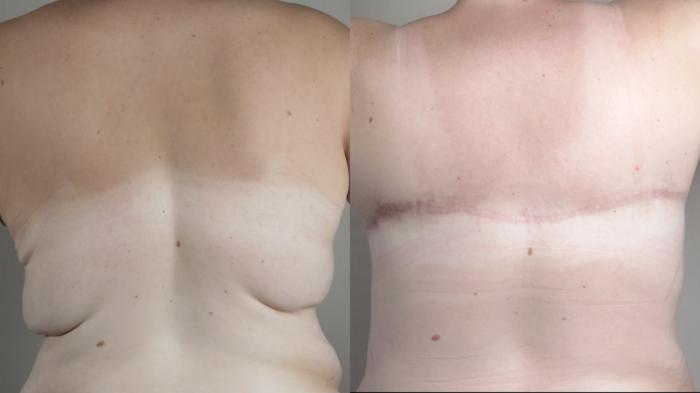 Upper Arm Rejuvenation Case 1320 Before & After bra line 2 | Paramus, New Jersey | Parker Center for Plastic Surgery