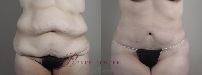 Upper Arm Rejuvenation Case 1320 Before & After Front | Paramus, NJ | Parker Center for Plastic Surgery