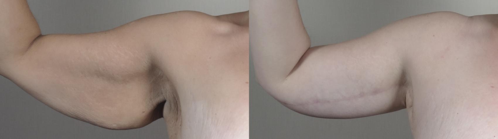 Upper Arm Rejuvenation Case 1320 Before & After Right Side | Paramus, New Jersey | Parker Center for Plastic Surgery