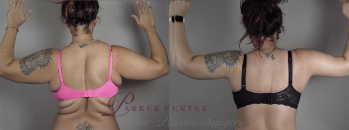 Upper Arm Rejuvenation Case 1322 Before & After Back | Paramus, NJ | Parker Center for Plastic Surgery