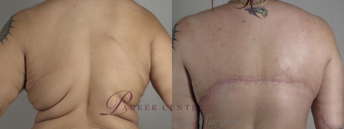 Upper Arm Rejuvenation Case 1322 Before & After back view 2 braless  | Paramus, NJ | Parker Center for Plastic Surgery