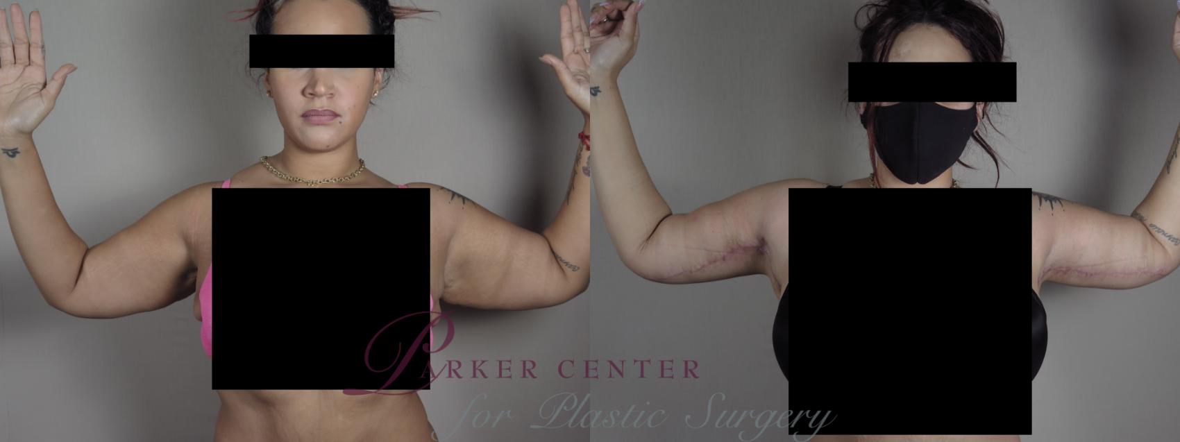 Upper Arm Rejuvenation Case 1322 Before & After Front | Paramus, NJ | Parker Center for Plastic Surgery