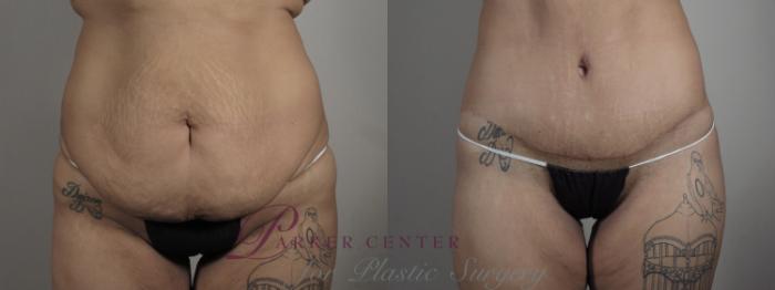 Upper Arm Rejuvenation Case 1322 Before & After front view 2  | Paramus, NJ | Parker Center for Plastic Surgery