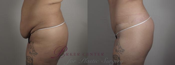 Upper Arm Rejuvenation Case 1322 Before & After Left Side | Paramus, NJ | Parker Center for Plastic Surgery