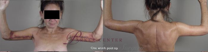 Upper Arm Rejuvenation Case 1366 Before & After 1 week  | Paramus, New Jersey | Parker Center for Plastic Surgery