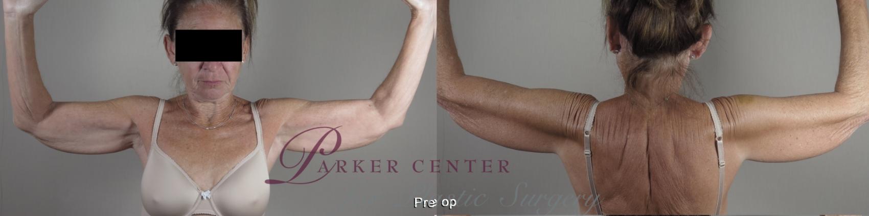 Upper Arm Rejuvenation Case 1366 Before & After pre op  | Paramus, New Jersey | Parker Center for Plastic Surgery