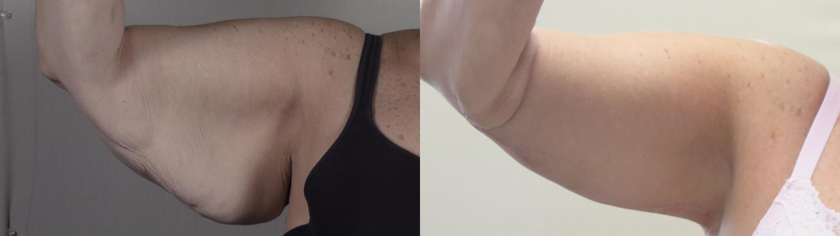 Upper Arm Rejuvenation Case 1395 Before & After Front | Paramus, New Jersey | Parker Center for Plastic Surgery