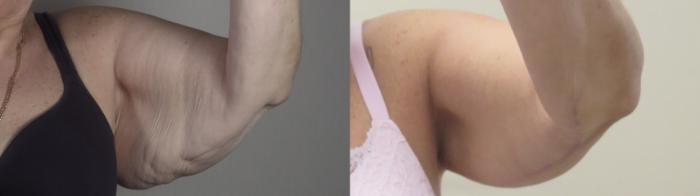 Upper Arm Rejuvenation Case 1395 Before & After Right Side | Paramus, New Jersey | Parker Center for Plastic Surgery