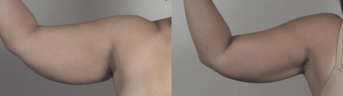 Upper Arm Rejuvenation Case 1483 Before & After Right Side | Paramus, New Jersey | Parker Center for Plastic Surgery