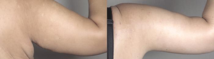 Upper Arm Rejuvenation Case 1492 Before & After back 2 | Paramus, New Jersey | Parker Center for Plastic Surgery