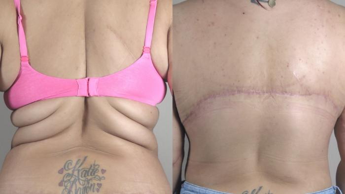 Upper Arm Rejuvenation Case 1492 Before & After back bra line | Paramus, New Jersey | Parker Center for Plastic Surgery