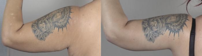 Upper Arm Rejuvenation Case 1492 Before & After Back | Paramus, New Jersey | Parker Center for Plastic Surgery