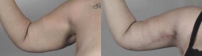 Upper Arm Rejuvenation Case 1492 Before & After Right Side | Paramus, New Jersey | Parker Center for Plastic Surgery