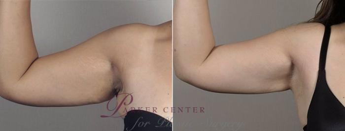 Upper Arm Rejuvenation Case 558 Before & After View #5 | Paramus, NJ | Parker Center for Plastic Surgery
