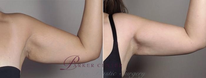 Upper Arm Rejuvenation Case 558 Before & After View #6 | Paramus, NJ | Parker Center for Plastic Surgery