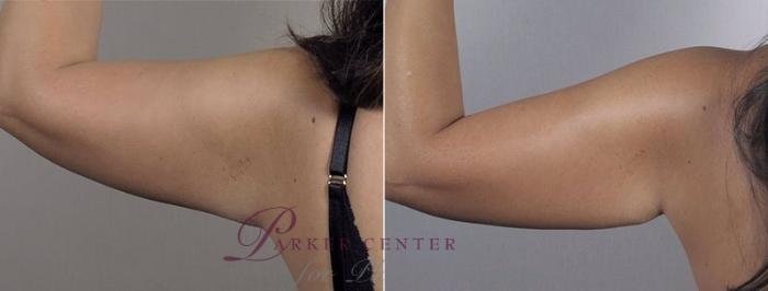Upper Arm Rejuvenation Case 558 Before & After View #7 | Paramus, NJ | Parker Center for Plastic Surgery