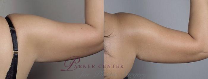 Upper Arm Rejuvenation Case 558 Before & After View #8 | Paramus, NJ | Parker Center for Plastic Surgery