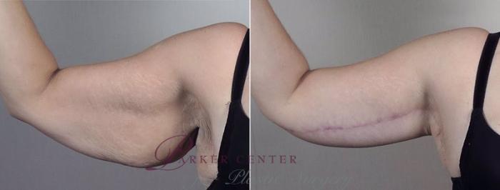 Upper Arm Rejuvenation Case 749 Before & After View #4 | Paramus, NJ | Parker Center for Plastic Surgery