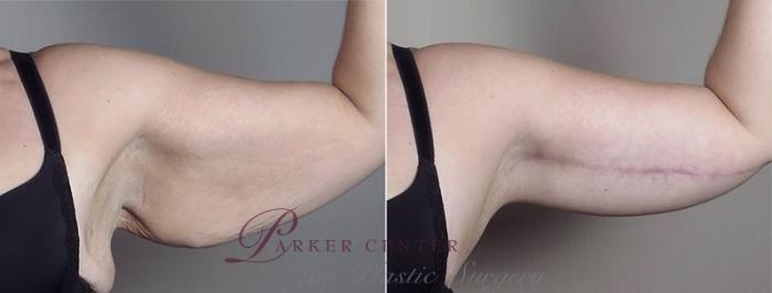 Upper Arm Rejuvenation Case 749 Before & After View #5 | Paramus, NJ | Parker Center for Plastic Surgery